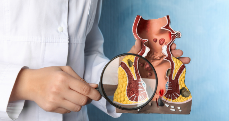 Laser Piles Treatment – Modern and Minimally Invasive